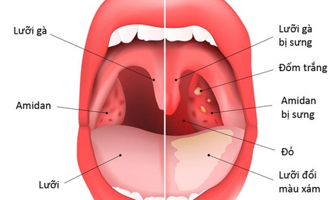 Viêm amidan, chớ để thành mạn tính