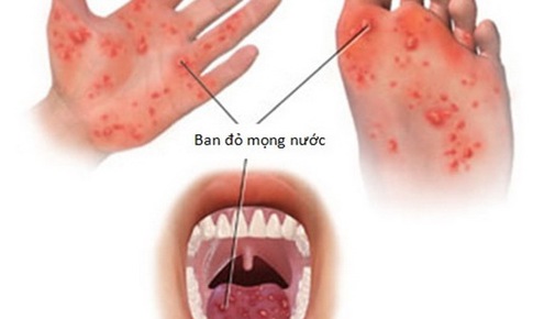 Một số bệnh dễ mắc phải nếu bạn c&#243; th&#243;i quen vệ sinh kh&#244;ng tốt