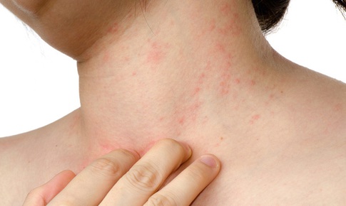 Mắc bệnh vẩy nến v&#236; sao?