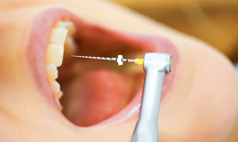 Tại sao cần điều trị tủy ch&#226;n răng?