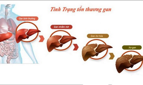 Những bệnh lý nguy hại khi tửu lượng... vô giới hạn