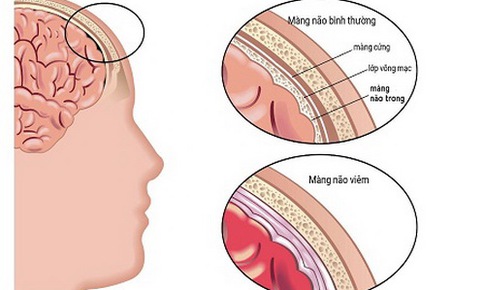 Tử vong v&#236; vi&#234;m m&#224;ng n&#227;o do virut: Cần nhận biết sớm v&#224; ph&#242;ng bệnh