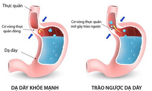 B&#224;i thuốc trị bệnh tr&#224;o ngược dạ d&#224;y - thực quản