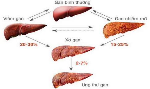 B&#224;i thuốc chữa bệnh gan do rượu