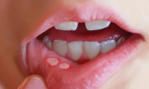 Truy “thủ phạm” gây loét miệng ở trẻ