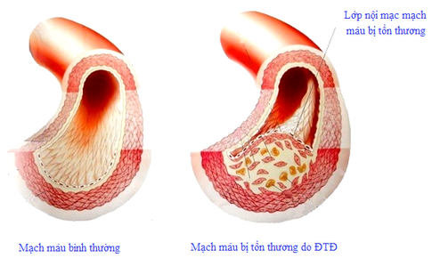 Bệnh của mạch máu có liên quan đến tai