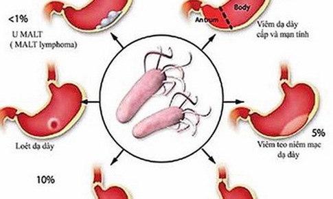 Nhiễm vi khuẩn HP c&#243; đ&#225;ng lo?