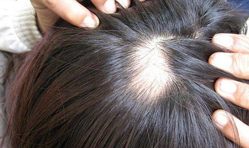 Khắc phục chứng rụng tóc