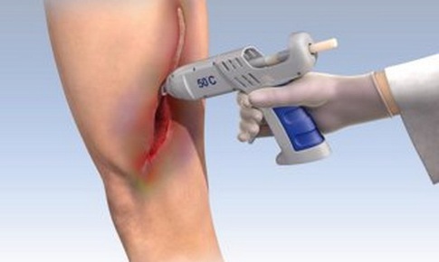 Súng bắn gel thay thế vết khâu: Ứng dụng y học nhiều triển vọng