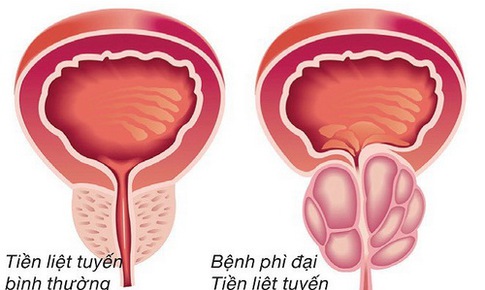 Ph&#236; đại tuyến tiền liệt c&#243; ảnh hưởng tới chuyện ph&#242;ng the?