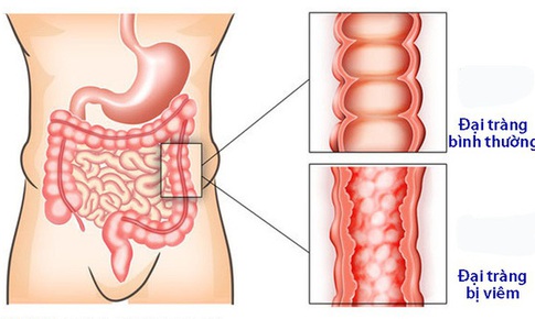 Dấu hiệu bệnh vi&#234;m đại tr&#224;ng co thắt