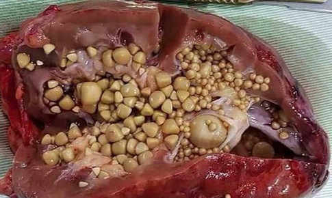 Đừng để thận trở th&#224;nh nơi chứa sỏi