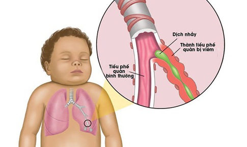 Biến chứng do vi&#234;m tiểu phế quản ở trẻ em