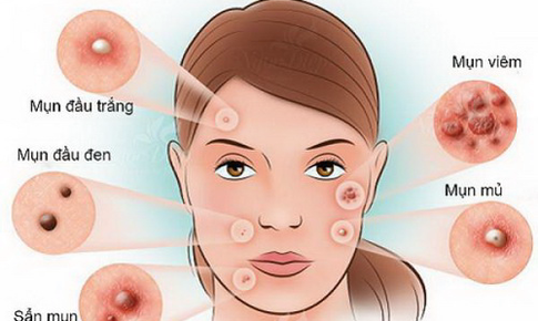 Mụn trứng cá - Hiểu đúng để tránh biến chứng
