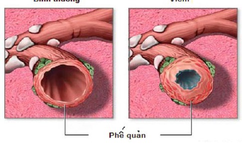 Ph&#242;ng biến chứng vi&#234;m phế quản cấp