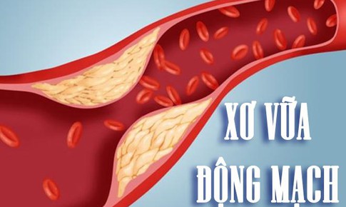 Xơ vữa động mạch n&#234;n ăn g&#236;?