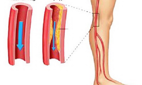 Nhận biết bệnh động mạch chi dưới mạn t&#237;nh