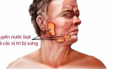 Bệnh quai bị c&#243; ảnh hưởng đến thai nhi?