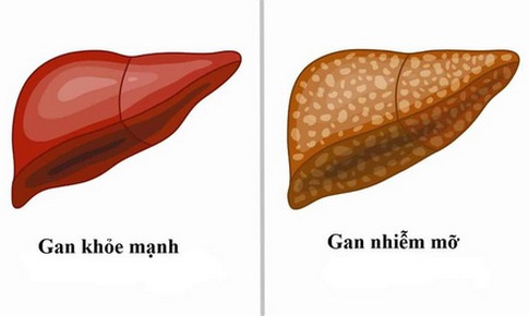 Thuốc nào trị gan nhiễm mỡ?