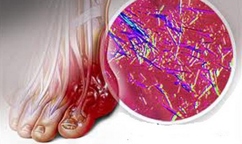 Tăng acid uric m&#225;u, kh&#244;ng chỉ lo bị g&#250;t