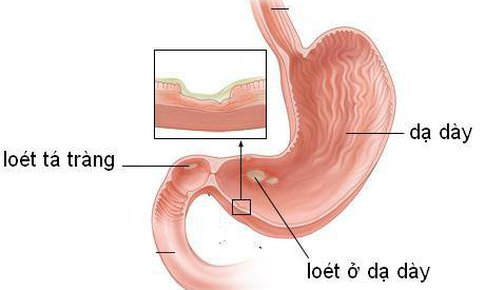 Thảo dược trị vi&#234;m dạ d&#224;y t&#225; tr&#224;ng