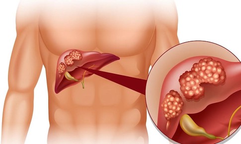 Bệnh vi&#234;m gan ảnh hưởng tới “chuyện ấy” thế n&#224;o?