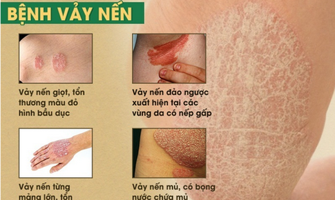 Đối ph&#243; với bệnh vẩy nến