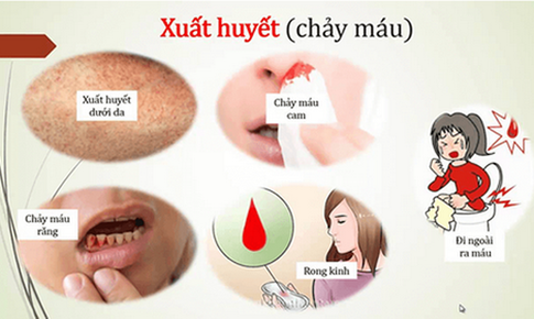 Nhận biết sớm giai đoạn nguy hiểm của sốt xuất huyết