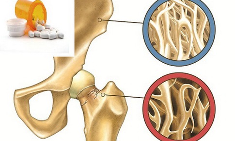 D&#249;ng bisphosphonate trị lo&#227;ng xương: Một số nguy cơ cần lưu &#253;