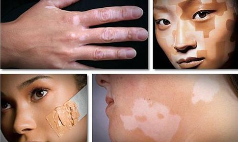 Bệnh bạch biến c&#243; chữa khỏi kh&#244;ng?