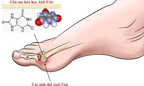 L&#224;m g&#236; để giảm axit uric trong m&#225;u?