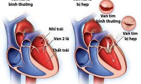 Bệnh van tim c&#243; nguy hiểm kh&#244;ng?