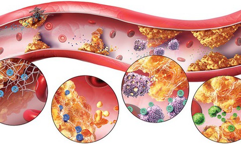 Chỉ số đ&#225;nh gi&#225; rối loạn mỡ m&#225;u