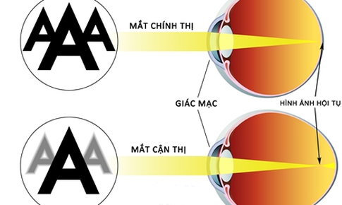 Tật kh&#250;c xạ v&#224; k&#237;nh tiếp x&#250;c sử dụng trong điều trị tật kh&#250;c xạ