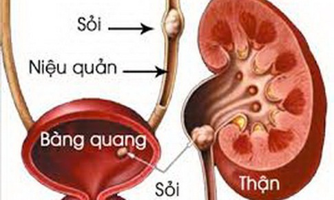 Biện ph&#225;p ngăn ngừa sỏi thận