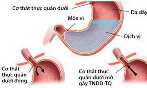 Co thắt thực quản c&#243; chữa được kh&#244;ng?