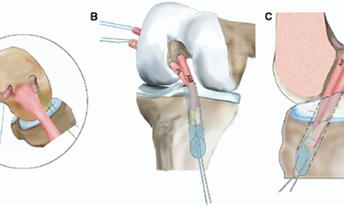 Phẫu thuật điều trị đứt d&#226;y chằng ch&#233;o trước