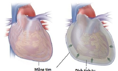 Bệnh vi&#234;m m&#224;ng ngo&#224;i tim co thắt c&#243; thể dẫn tới suy tim