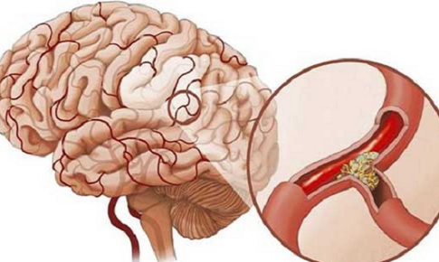 Một số biện pháp ngừa tai biến mạch máu não