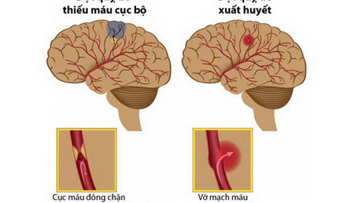 Nhận biết cơn thiếu m&#225;u n&#227;o cục bộ tho&#225;ng qua