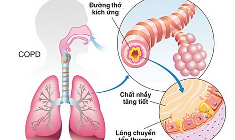 Phải tu&#226;n thủ d&#249;ng thuốc trị COPD