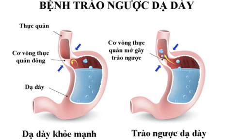 Triệu chứng tr&#224;o ngược dạ d&#224;y - thực quản