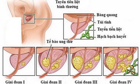 Dấu hiệu “tố” ung thư tuyến tiền liệt