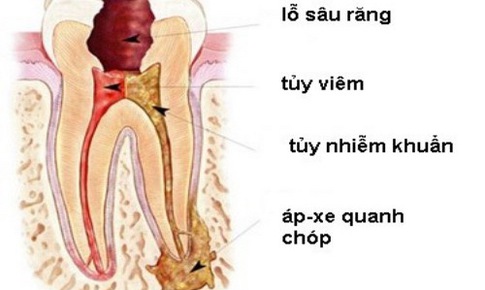 Ph&#242;ng vi&#234;m nhiễm h&#224;m mặt