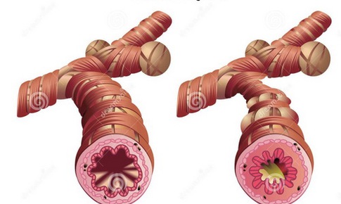 Chăm sóc bé mắc bệnh hen đúng cách, giảm biến chứng