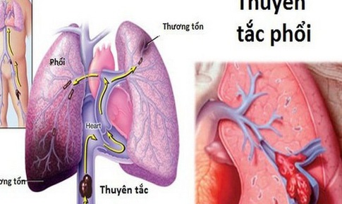 Nhận biết sớm huyết khối tĩnh mạch s&#226;u