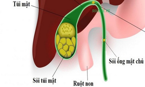 C&#225;ch ph&#242;ng tr&#225;nh sỏi mật hiệu quả