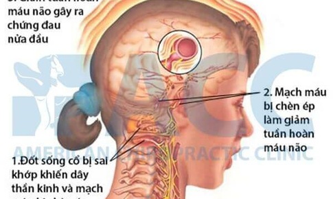 Chứng đau nửa đầu v&#224; c&#225;ch xử tr&#237;