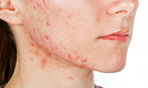 Làm gì khi bị trứng cá?