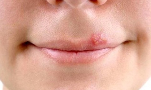 Rộp m&#244;i c&#243; l&#226;y kh&#244;ng?